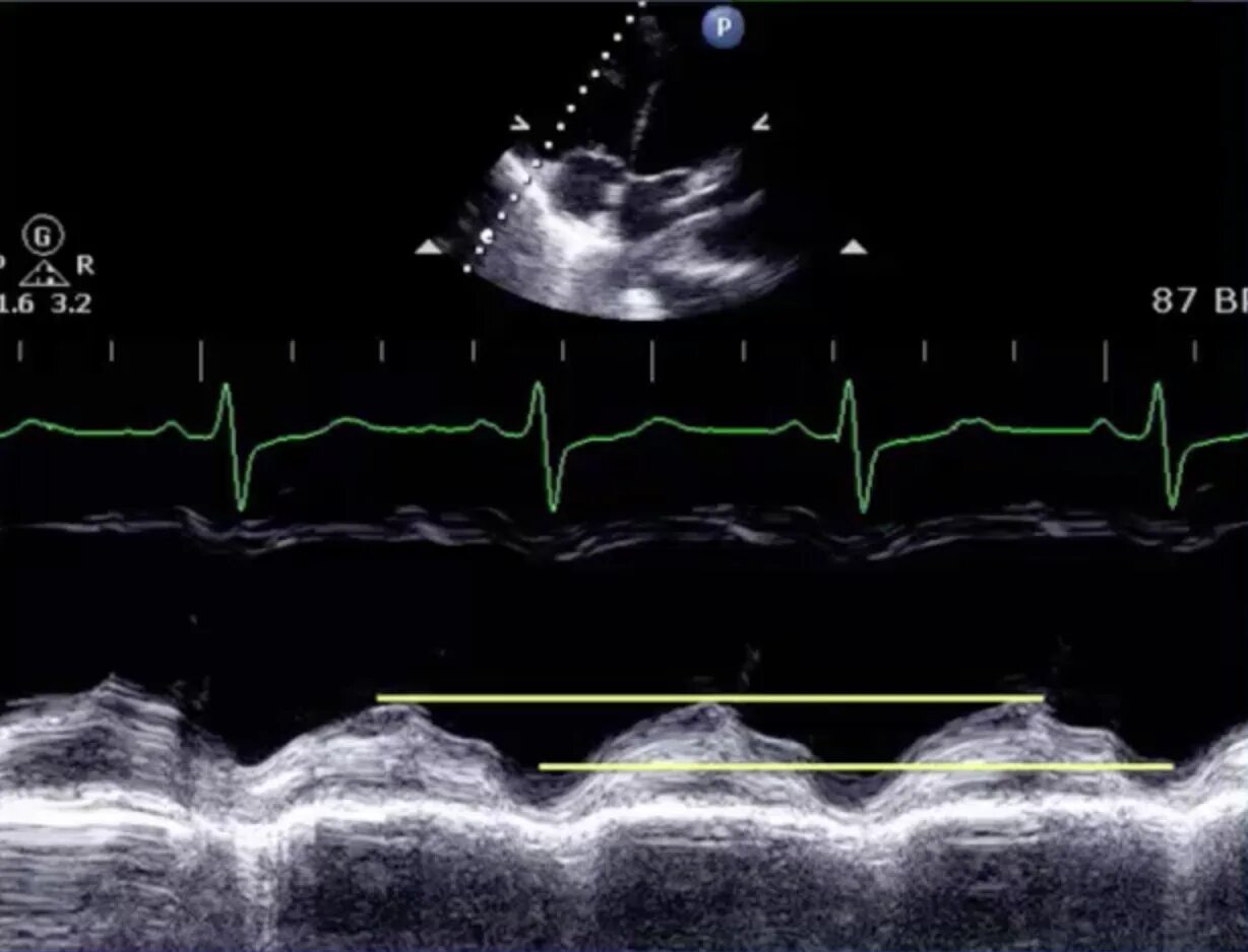 Быстро эхо. Tapse эхокардиография что это. Mapse эхокардиография норма. EPSS эхокардиография. Измерение tapse правого желудочка.
