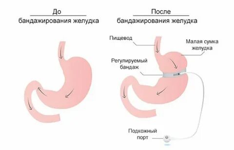 Какие операции для похудения