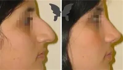 Форум операции носа. Ринопластика Агапов до и после.