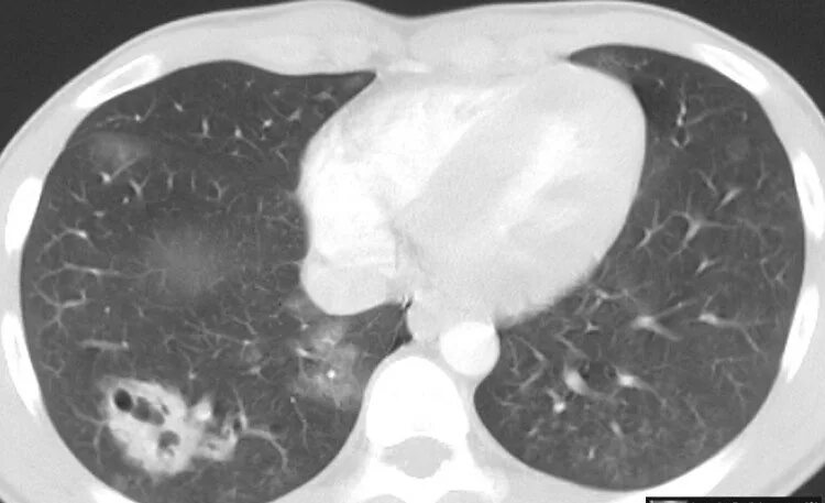Ушиб легкого на кт. Тотальный пневмоторакс кт. Ушиб легкого на кт. Ушиб легкого на кт. Внутрилегочная гематома кт.