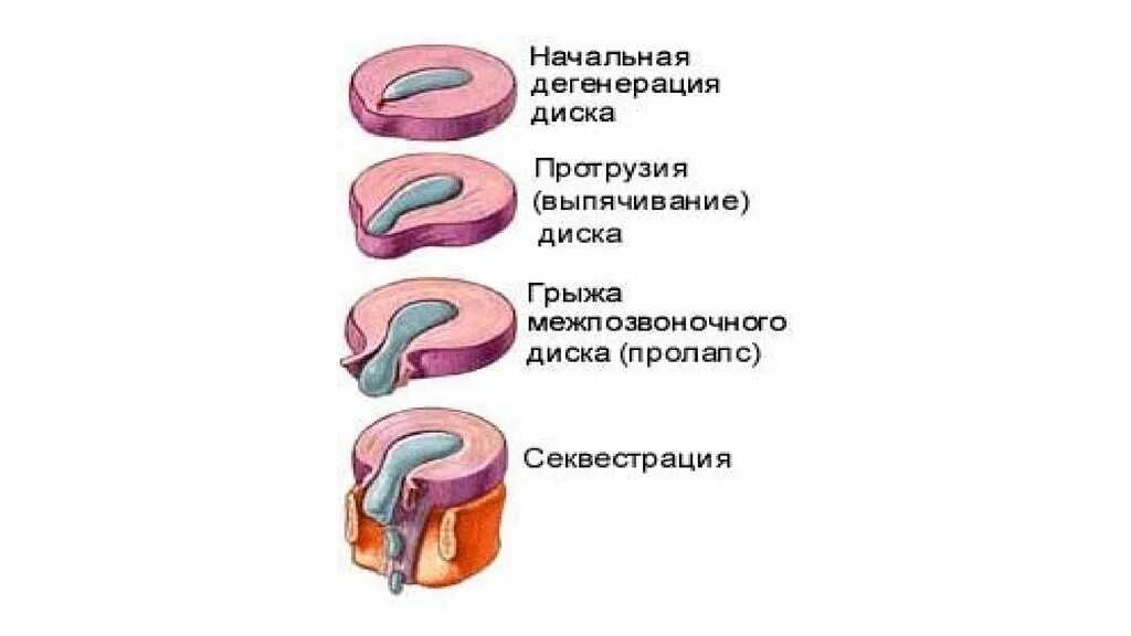 Дегенерация дисков