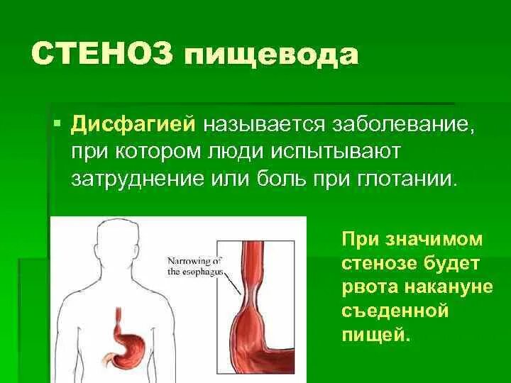 Пищевод человека. Боли при заболеваниях пищевода. Пищевод человека симптомы заболевания. Какая болезнь пищевода