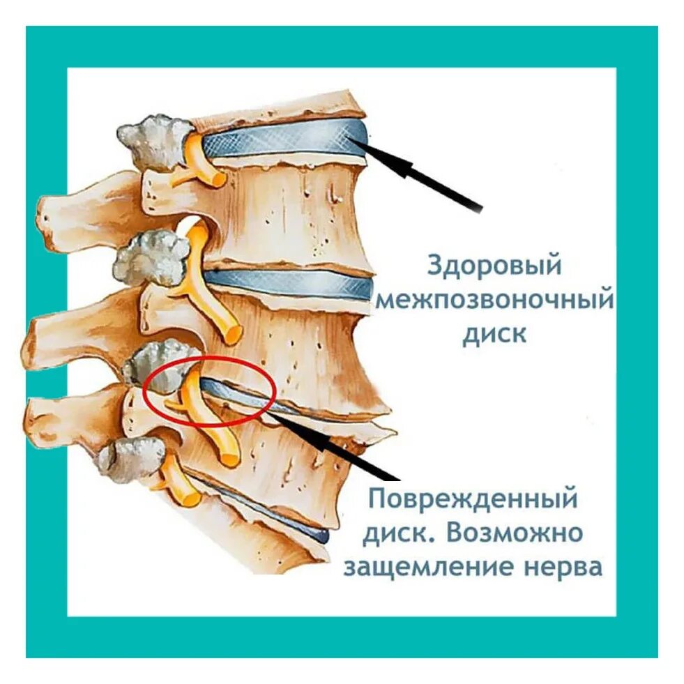 Зажало нерв в пояснице. Защемление нерва симптомы. Защемление нерва в спи. Защемило поясничный нерв. Защемление позвоночника.