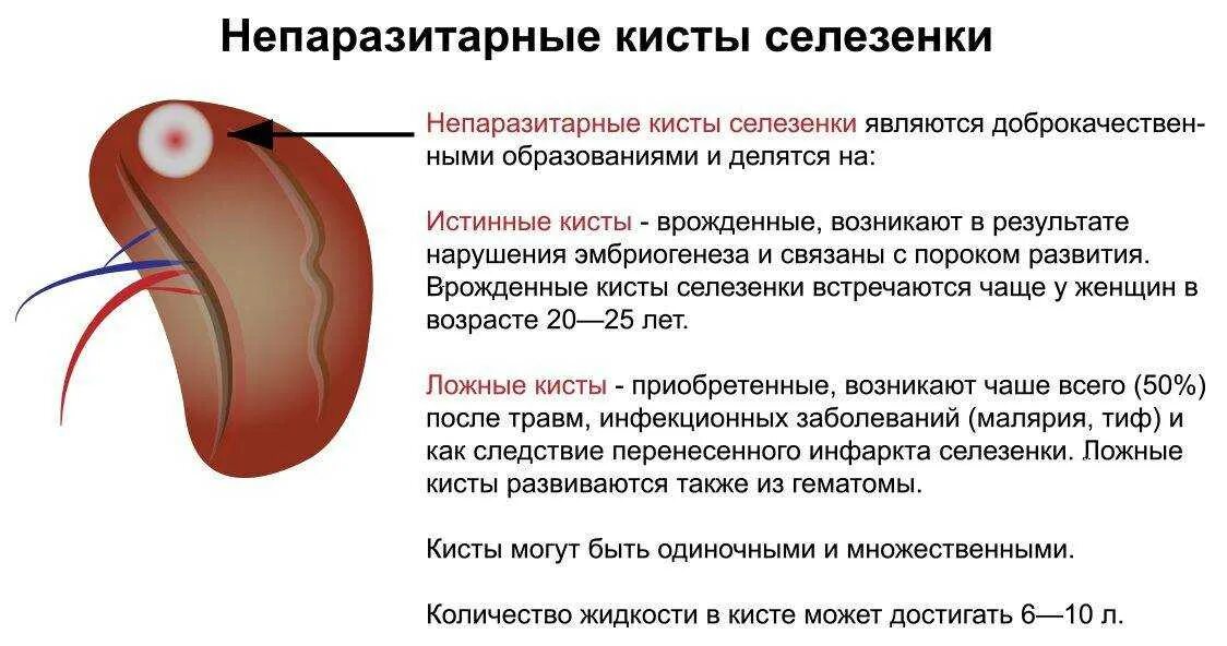 Селезенка может болеть. Паразитарная киста селезенки. Непаразитарная киста селезенки. Кистозное образование селезенки. Киста селезёнки симптомы у взрослого.