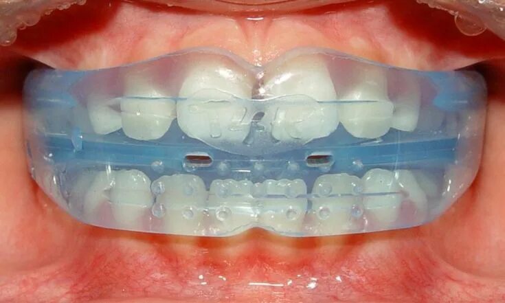 1Pcs Soft Orthodontic Brace Buck Teeth Retainers Boxing Tooth Protecto- Visit Ma