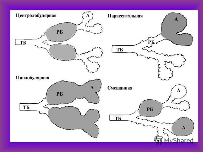 Хроническая обструктивная эмфизема легких классификация. Типы эмфиземы легких. Типы эмфиземы легких. Классификация эмфиземы лёгких. Эмфизема классификация.