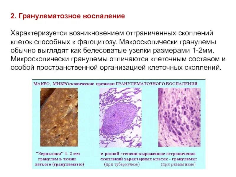 Морфологические изменения болезни. Гранулематозное воспаление патанатомия. Клетки воспаления патанатомия. Классификация воспаление патологическая анатомия. Продуктивное воспаление патанатомия.