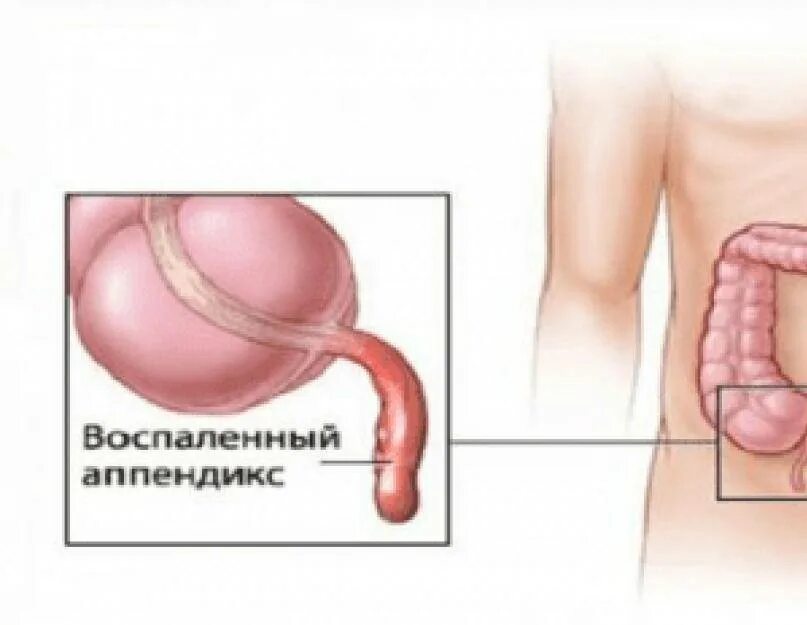 Воспаленный аппендикс. Воспалился аппендицит. Место расположения аппендикса. Локализация аппендицита.