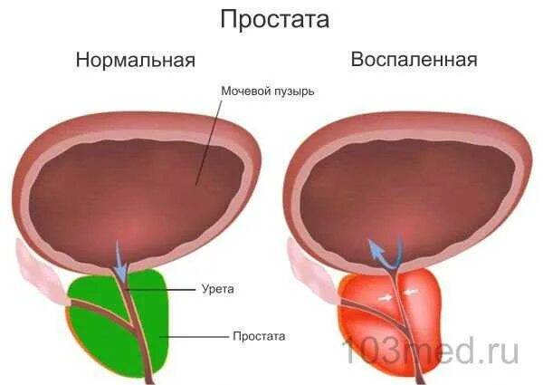 Кровь у мужчины из мочевого. Заболевания предстательной железы. Мочевой пузырь простатит. Воспаление в предстательной железе. Простатит рисунок.