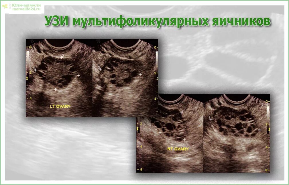 Мультифолликулярные поликистоз яичников. Мультифолликулярный яичник УЗИ. УЗИ признаки поликистоза яичников. Нормальные яичники на УЗИ И мультифолликулярные яичники. Мфя в гинекологии что