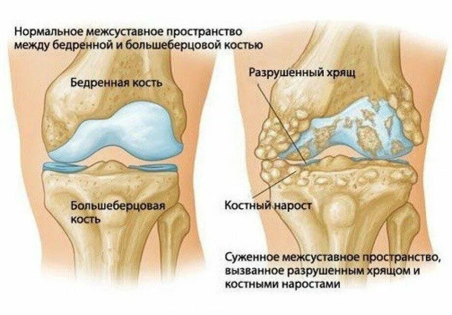 Гонартроза 2 степени коленного сустава. Деформирующий гонартроз коленного сустава. Суставной хрящ коленного сустава 2 степени. Симптомы гонартроза коленного сустава. Что разрушает суставы