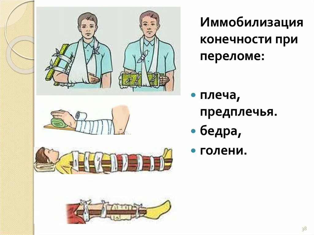 1 помощь при переломе верхней конечности. Иммобилизация конечности при переломе. Иммобилизация при переломе верхних и нижних конечностей. Иммобилизация при переломе бедра ОБЖ. Иммобилизация конечности при переломе костей.