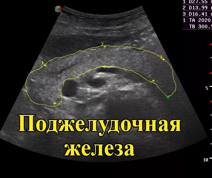 Как на узи выглядит рак поджелудочной железы Картинки ПРИЗНАКИ КИСТЫ ПОДЖЕЛУДОЧНОЙ ЖЕЛЕЗЫ
