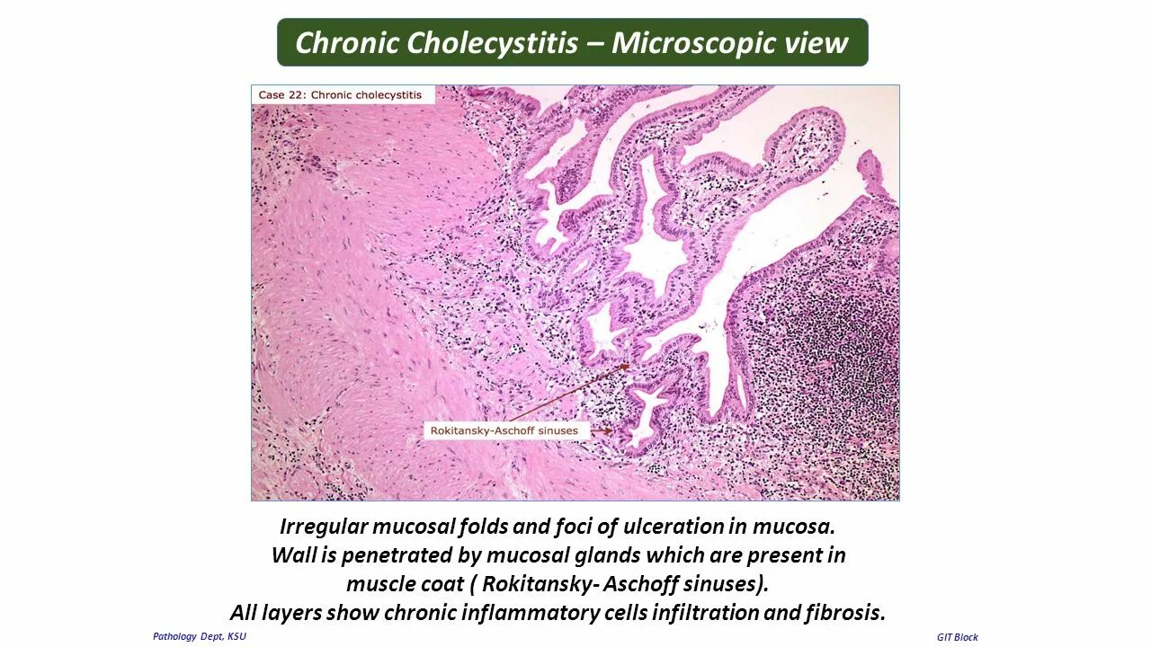 Синусы Рокитанского-Ашоффа гистология. Хронический атрофический холецистит гистология. Желчный пузырь катаральный холецистит гистология. Острый катаральный холецистит гистология.