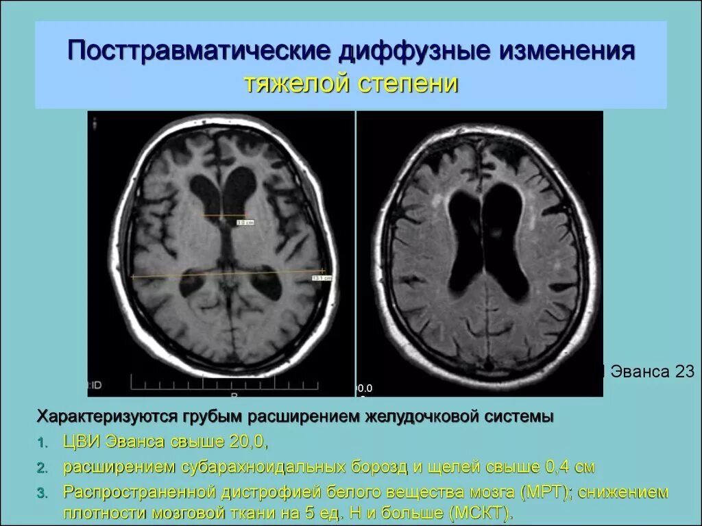 Что обозначает диффузный. Диффузные изменения. Посттравматические изменения головного мозга на кт. Цви Эванса. Что значит диффузные изменения.