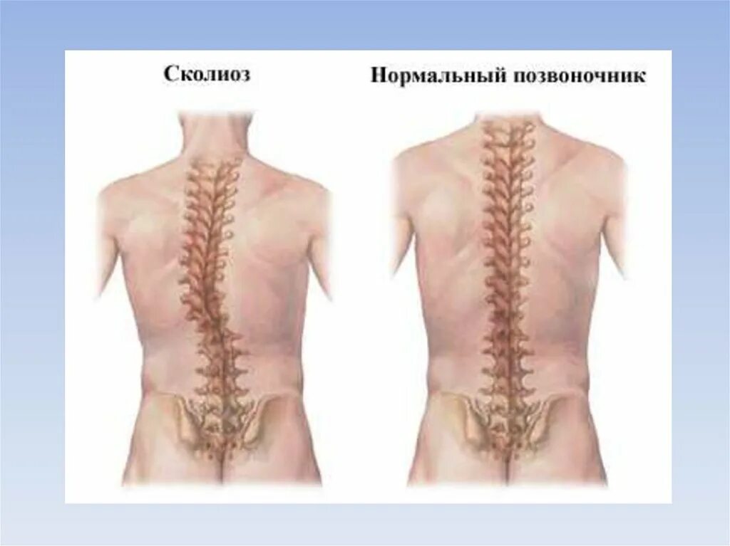 Нормальная поясница. Сильное искривление позвоночника. Сколиотическое искривление позвоночника.