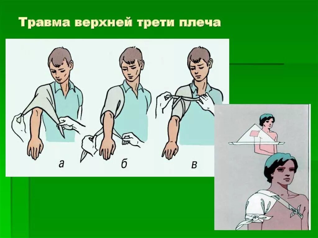 анатомия руки человека. средняя треть плеча это где. симптомы повреждения лучевого нерва на уровне плеча. границы плеча топографическая анатомия. трети плеча.