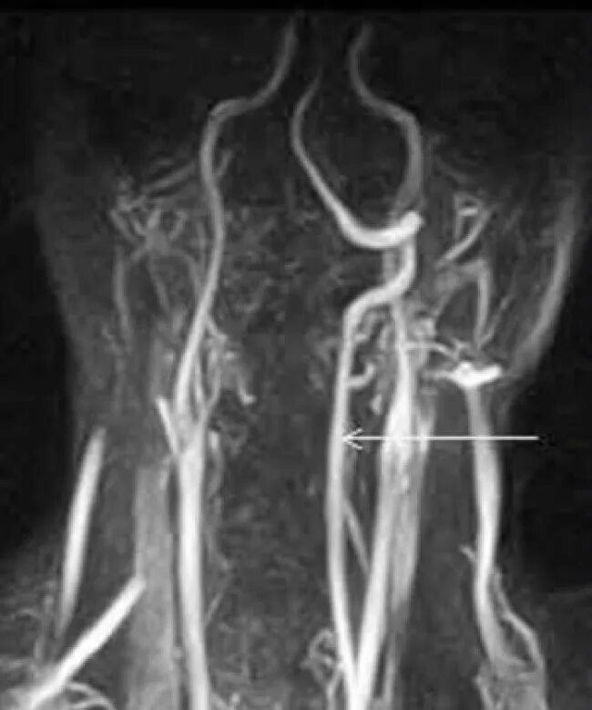 Гипоплазия v4 позвоночной артерии. Аплазия левой позвоночной артерии v4. Гипоплазия v4 сегмента правой позвоночной артерии. Гипоплазия левой позвоночной артерии. Гипоплазия правой артерии мозга