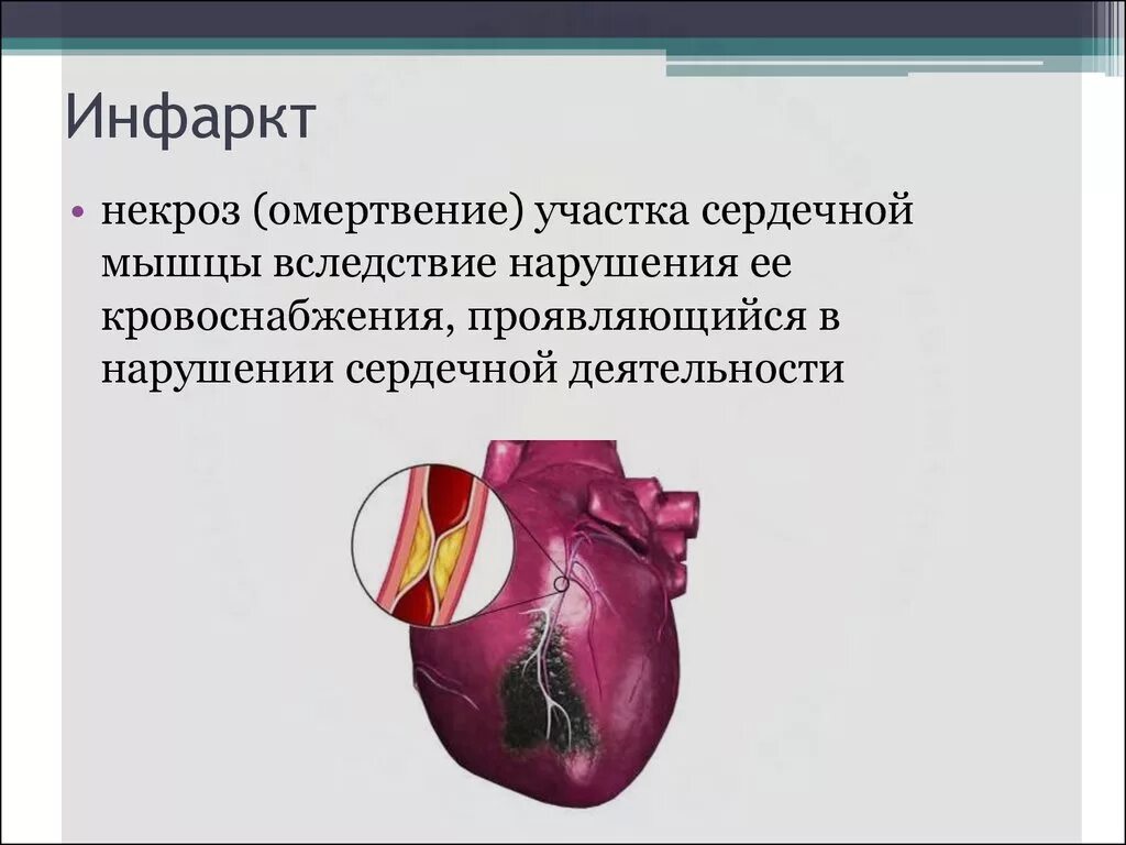 Инфаркт миокарда (некроз миокарда). Инфаркт это кратко в патологии. Некроз ткани инфаркт миокарда. Некроз сердечной мышцы.