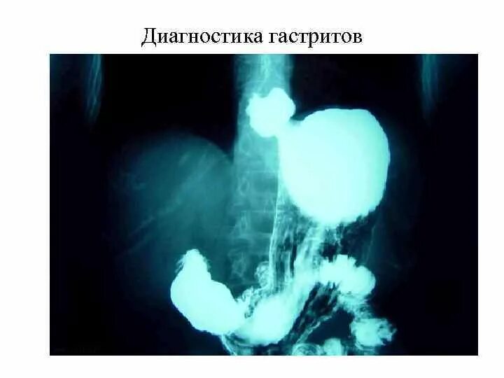 Пищевода с барием. Рентгеноскопия желудка грыжа. Рентгенография желудка ГЭРБ.