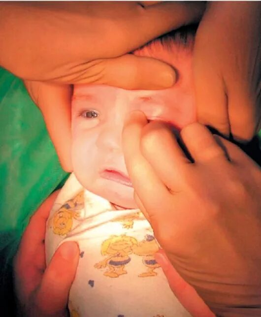 Массаж глаза у новорожденного. Дакриоцистит новорожденных. Дакриоцистит новорожденных массаж слезного канала у новорожденных. Дакриоцистит новорожденных массаж для новорожденных. Дакриоцистит массаж слезного канала у новорожденных.