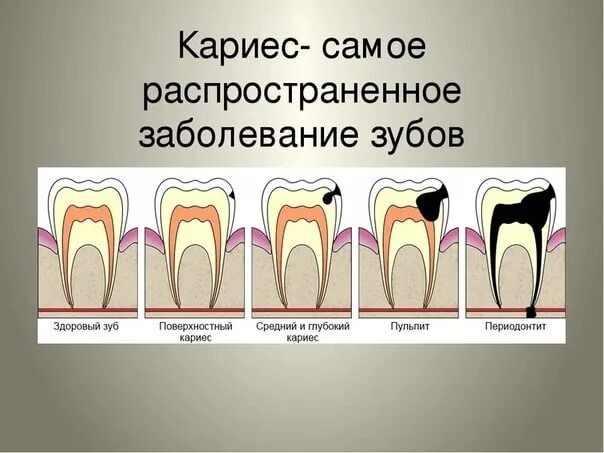 Скрытая патология. Заболевание поражающее эмаль и дентин зубов. Болезни зубов пародонтит кариес. Кариес пришеечный классификация. Кариозные поражения зубов кариес.