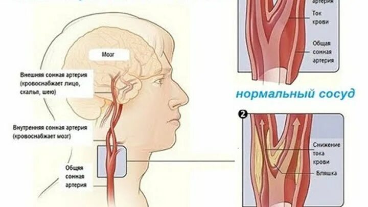 Сужение сосудов последствие. Спазмы сосудов головного мозга. Спазм сосудов шеи и головы. От спазма сосудов головного мозга.