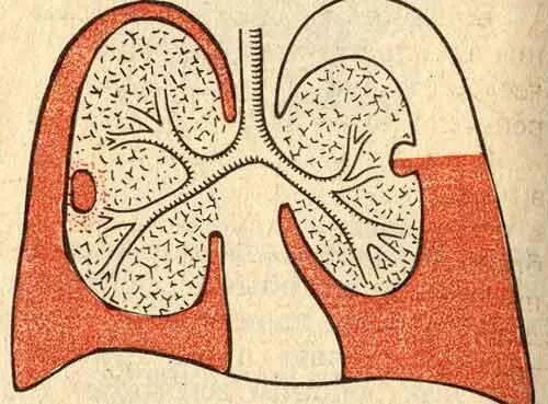 Эмпиема плевральной полости. Эмпиема плевры патанатомия. Эмпиема легкого