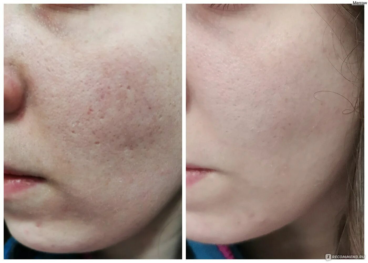 Сыворотка "anti-acne" smorodina. Сыворотка против комедонов. Professional anti acne booster цитолайф. Меди пил сыворотка с чайным деревом. Сыворотка от закрытых комедонов.