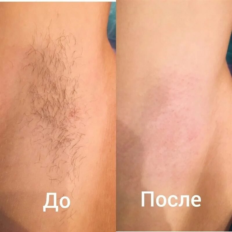 После восковой депиляции