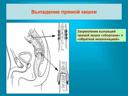 Застрял в прямой кишке