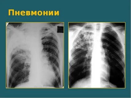 Чем отличается воспаление легких от