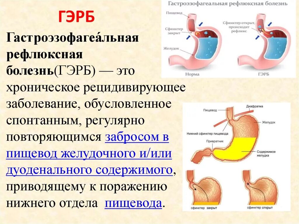 Рефлюкс кислоты