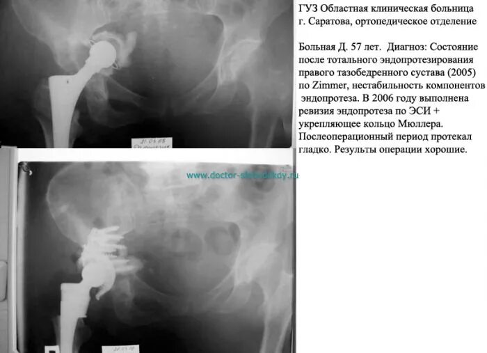 Ревизия тазобедренного сустава. Ревизия тазобедренного эндопротеза. ревизионное тотальное эндопротезирование тазобедренного сустава:. нестабильность эндопротеза тазобедренного сустава кт. укрепляющее кольцо эндопротез тазобедренного сустава.