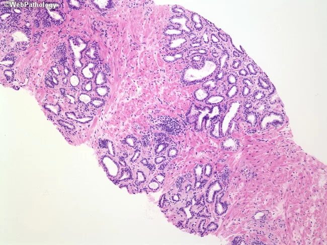 Железистая гиперплазия предстательной железы. Мелкоацинарная аденокарцинома гистология. Аденокарцинома предстательной железы гистология. Аденома простаты гистология. Предстательная железа микропрепарат гистология.