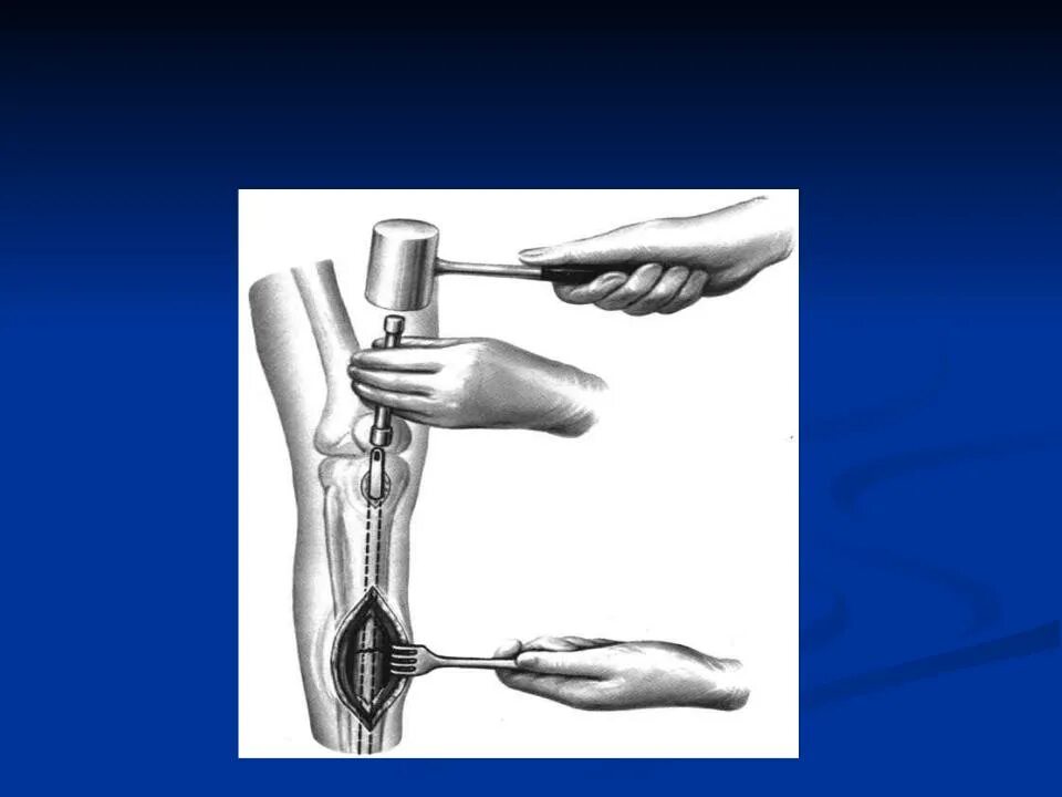 Внутрикостная блокада. Интрамедуллярный (внутрикостный) остеосинтез. Блокируемый интрамедуллярный остеосинтез большеберцовой кости. Биос остеосинтез большеберцовой кости. Интрамедуллярный остеосинтез ход операции.