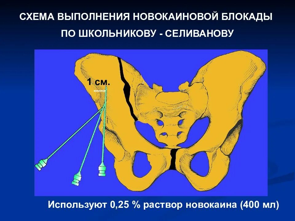 Техника выполнения внутритазовой блокады по Школьникову-Селиванову. Тазовая блокада по Школьникову Селиванову. Внутритазовая новокаиновая блокада по Школьникову. Блокада по Школьникову-Селиванову при переломах костей таза. Школьникова селиванова