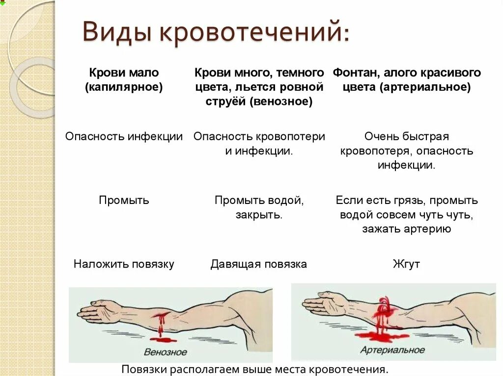 Способы остановки крови при разном виде кровотечения. Таблица вид кровотечения краткая характеристика способы остановки. ОБЖ виды кровотечений венозное артериальное.