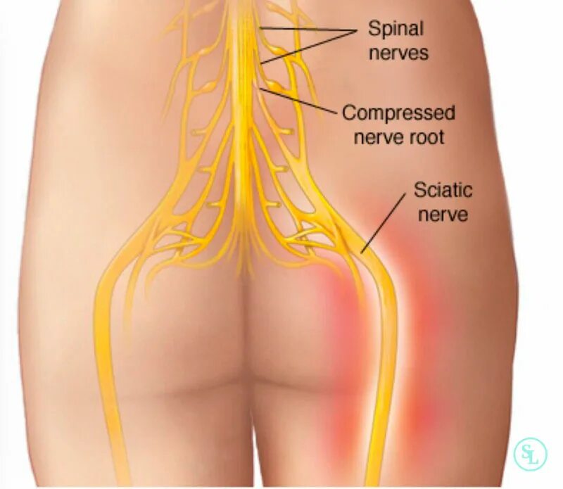 Боль в ягодицах причины у мужчины. Защемление седалищного нерва. Сидалеч седалищный нерв. Седалищный нерв ягодичный нерв. Защемление седалищного нервв.