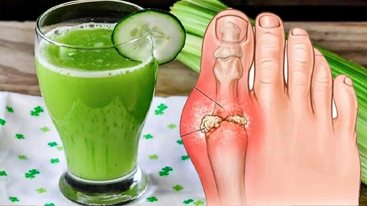 лечение суставов при подагре