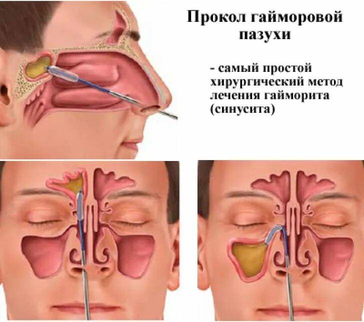 Что такое фронтит