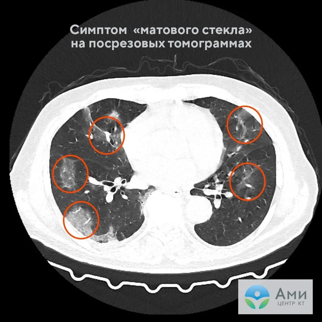Уплотнения паренхимы по типу
