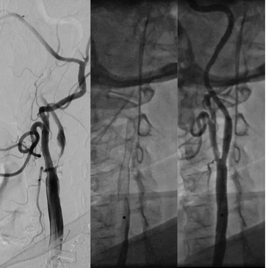 Стентирование видео. Стентирование сонной артерии. Стентирование бедренной артерии. Трифуркация сонной артерии. Стент для сонных артерий protege.