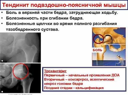 Трохантерит тазобедренного сустава признаки и лечение