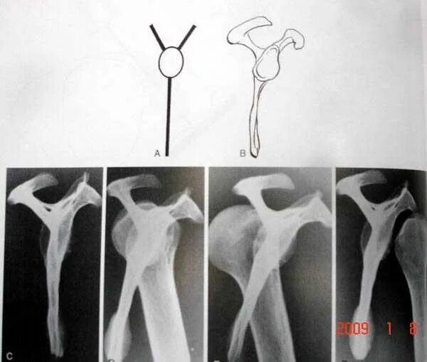 Абдукционный перелом шейки плечевой кости рентген. Виды перелома хирургической шейки плеча. Оскольчатый перелом хирургической шейки. Оскольчатый перелом хирургической шейки. Оскольчатый перелом бугорка плечевой кости.