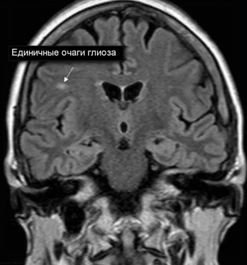 Глиоз в веществе головного мозга что такое. Кортикальный глиоз. Глиоз в головном мозге на мрт. Очаги глиоза в головном мозге мрт. Единичные очаги глиоза в белом веществе головного мозга мрт.