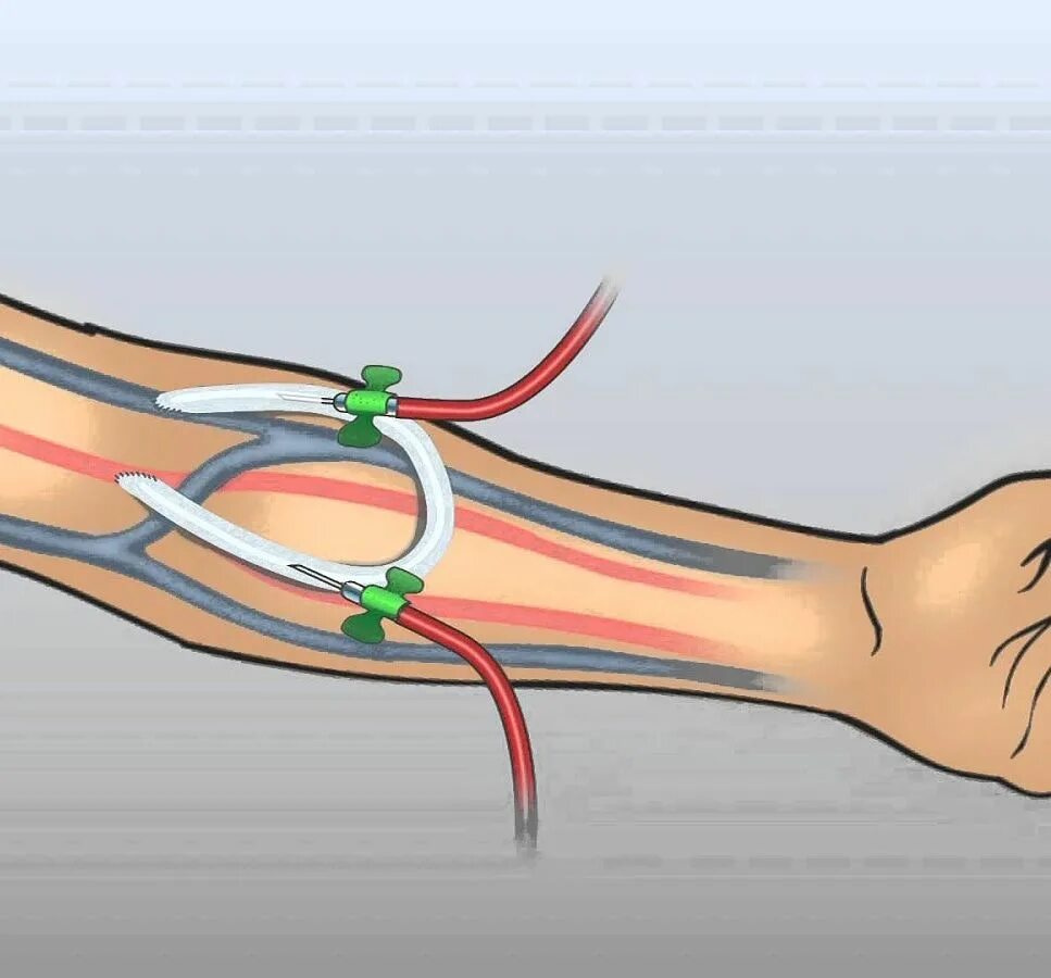Фистула. Артериально венозная фистула. Артериовенозная фистула диализ. Артериовенозный шунт для гемодиализа. Гемодиализ фистула гемодиализ.