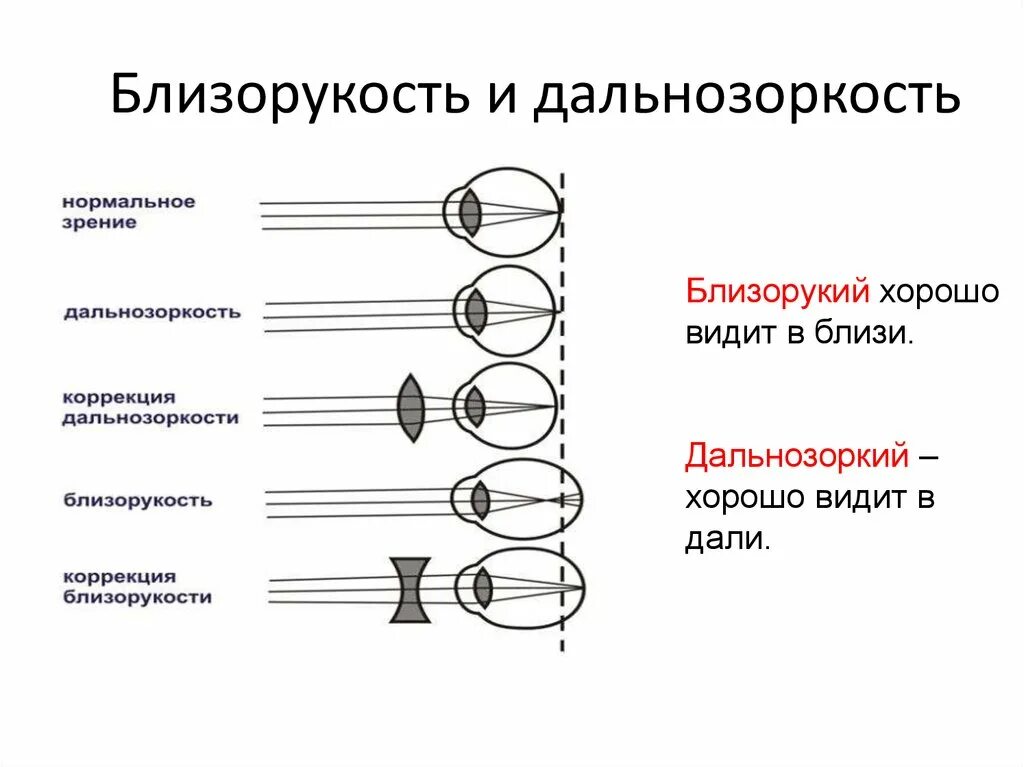 Способы коррекции миопии гиперметропии. Способы коррекции близорукости и дальнозоркости. Нормальное зрение близорукость дальнозоркость схема. Дефекты зрения близорукость, дальнозоркость, астигматизм. Близорукость причины возникновения