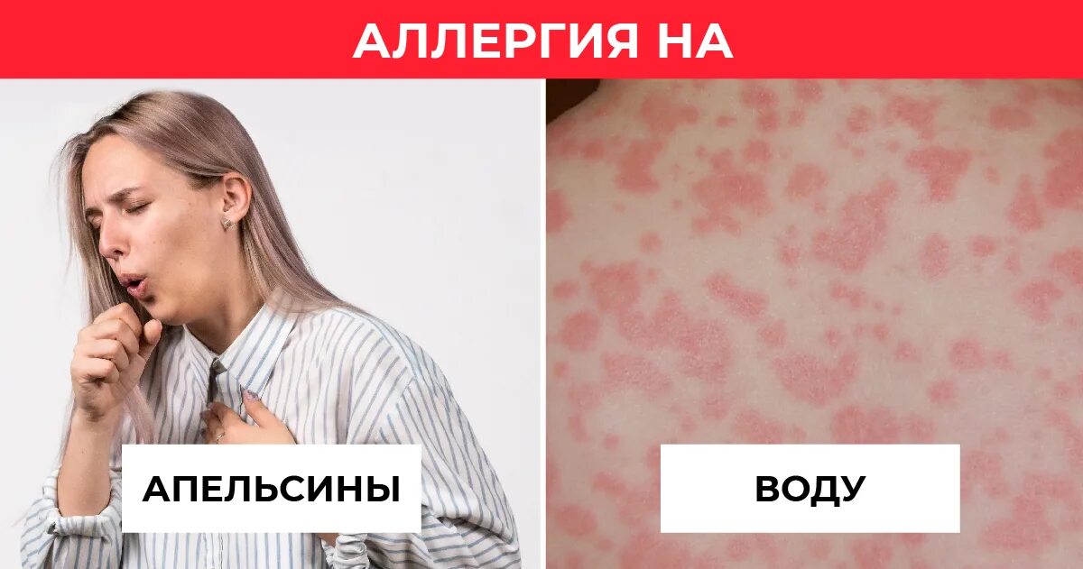 Аллергия: 5 нетипичных симптомов и способы их облегчить
