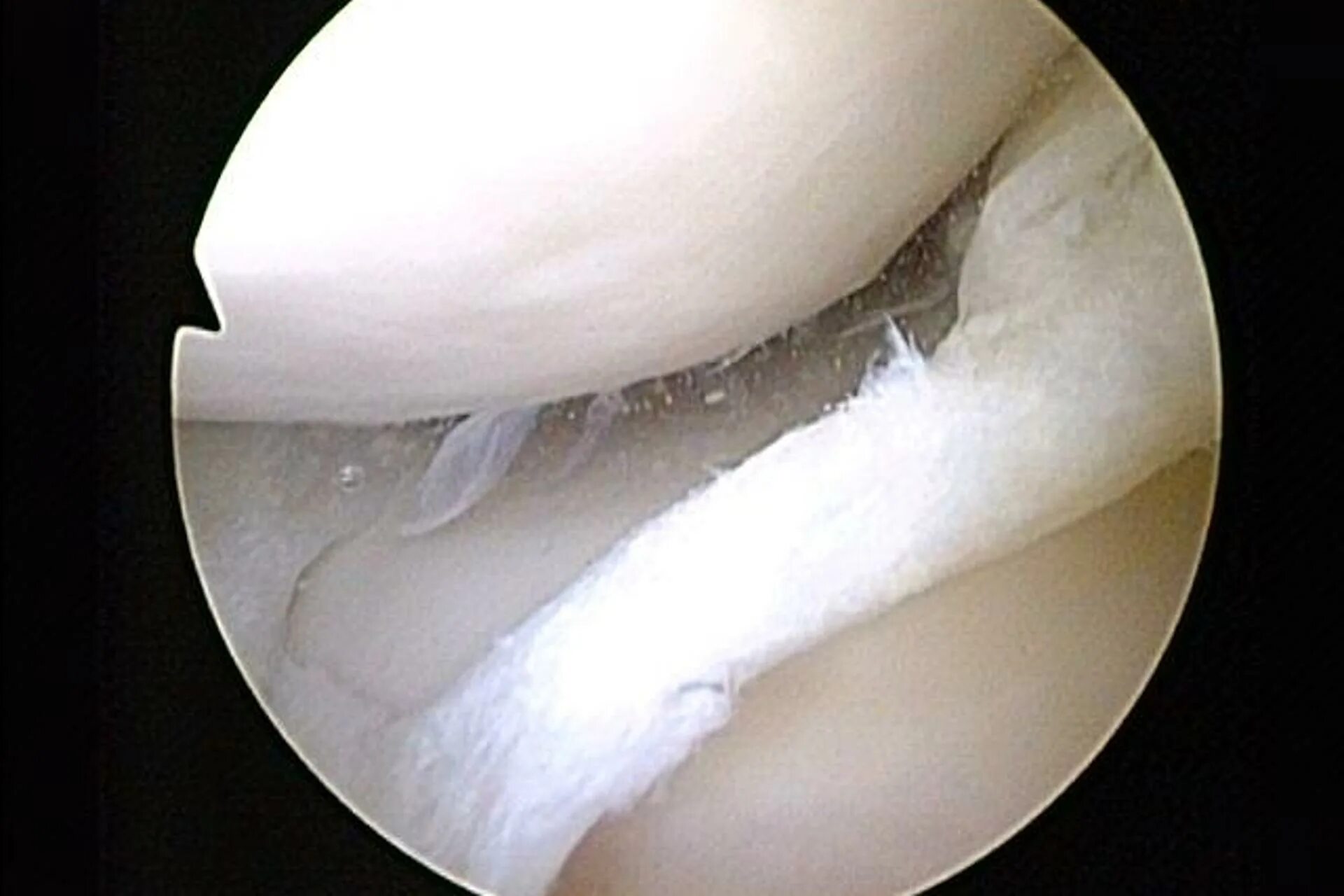 Артроскопическая резекция мениска. Разрыв рога медиального мениска операция. Резецированный медиальный мениск.